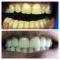 Zirconio-Ceramica superiore elementi 131211212223